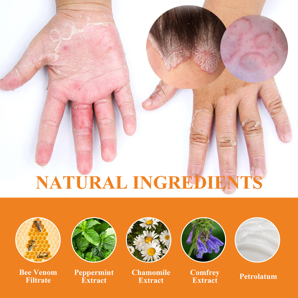 Crème Venin d'Abeille Psoriasis — Anti-Démangeaisons, Réparatrice & Hydratante