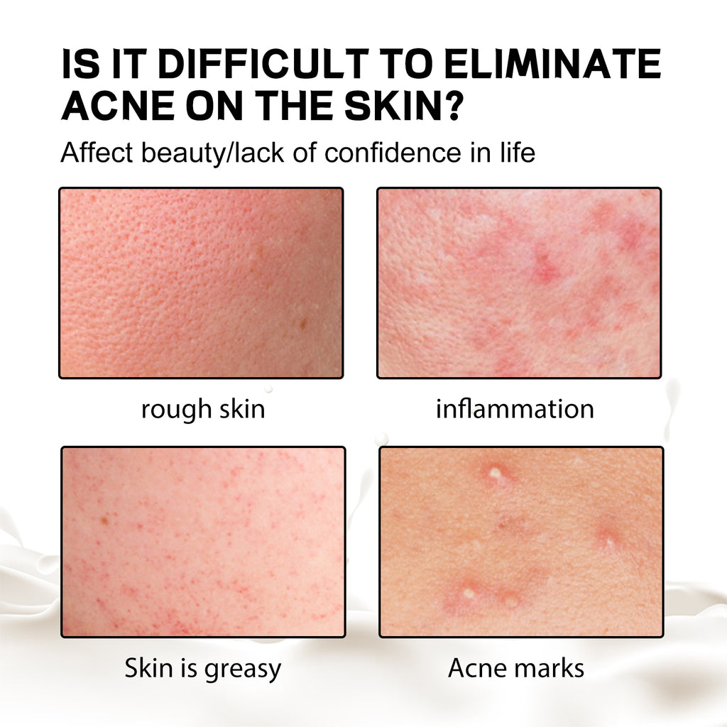 Savon Anti-Acné Dos Soie — Nettoyant Corps, Hydratant & Peau Lisse