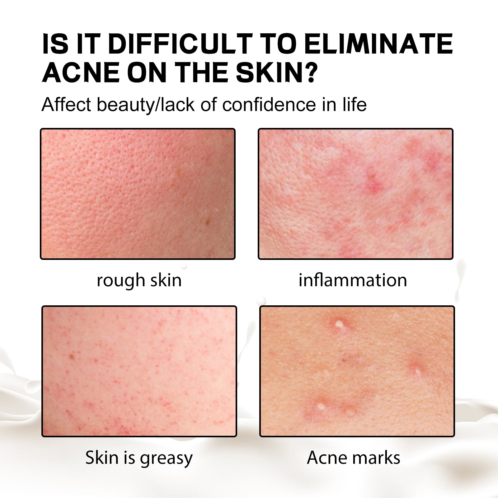 Savon Anti-Acné Dos Soie — Nettoyant Corps, Hydratant & Peau Lisse