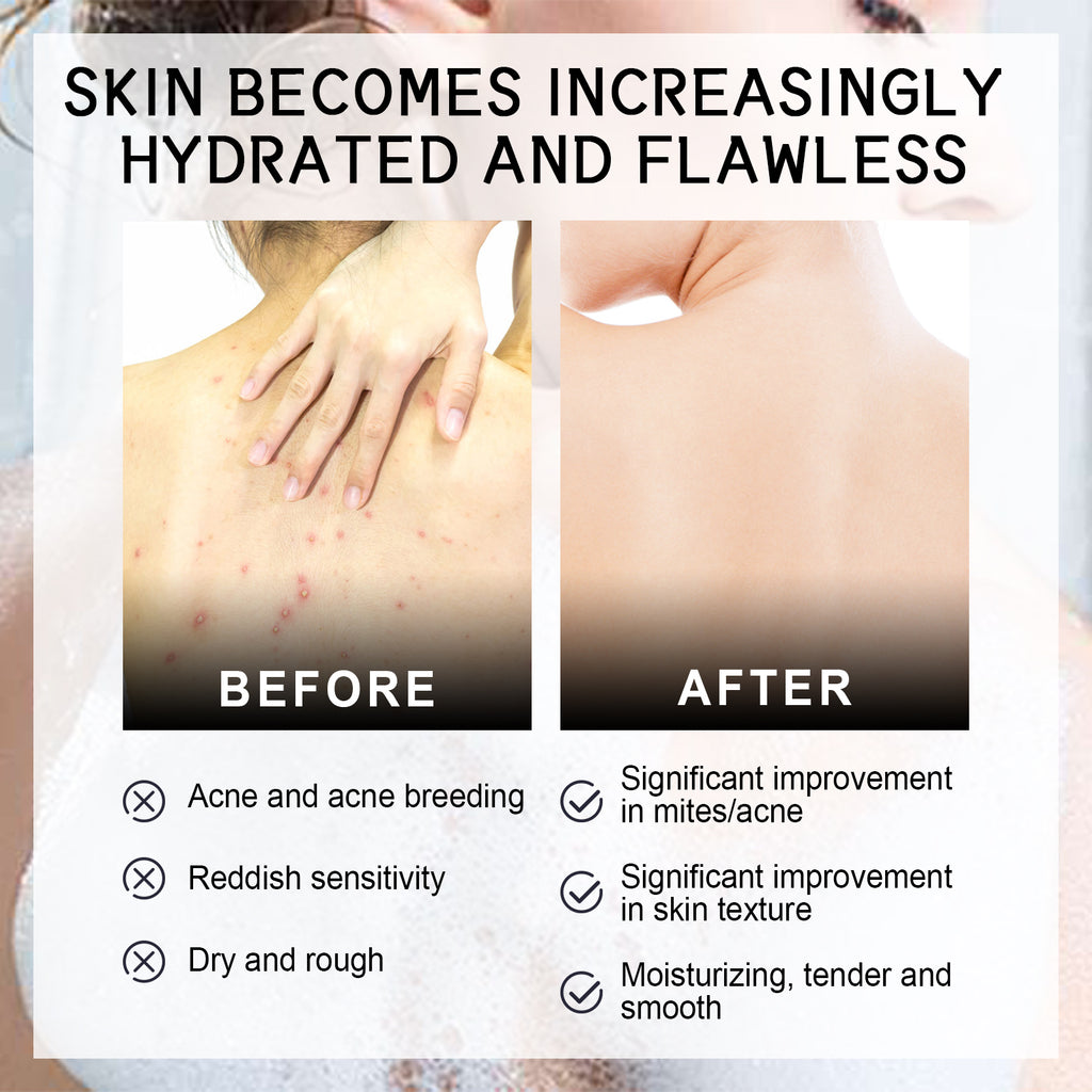 Savon Anti-Acné Dos Soie — Nettoyant Corps, Hydratant & Peau Lisse