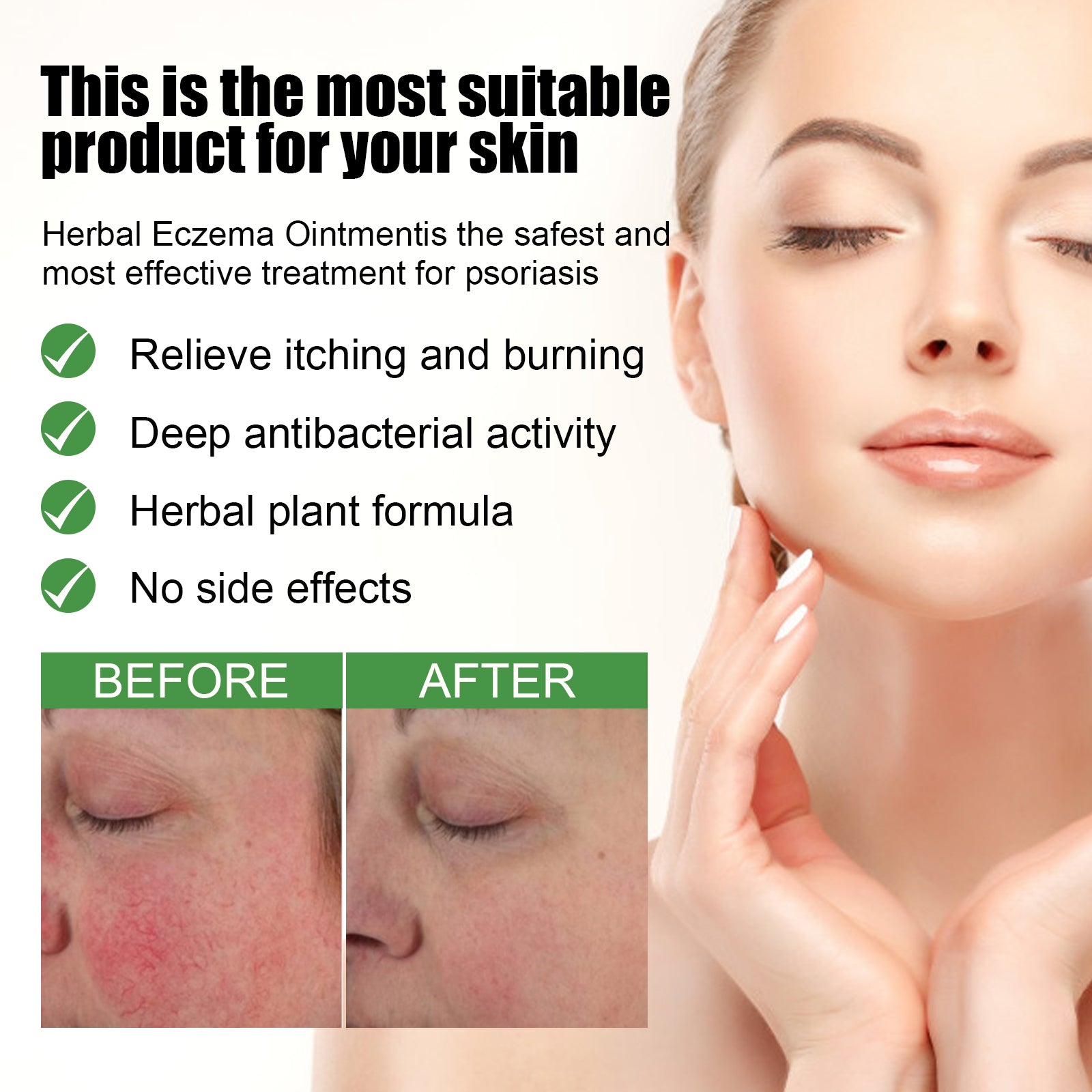 Pommade Herbes Eczema — Anti-Rougeurs, Anti-Démangeaisons & Réparatrice Mains & Pieds